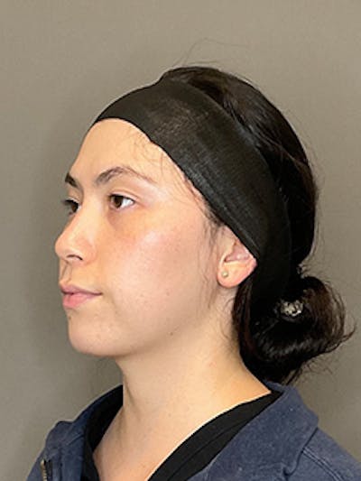 BioRePeel Before & After Gallery - Patient 180915 - Image 6