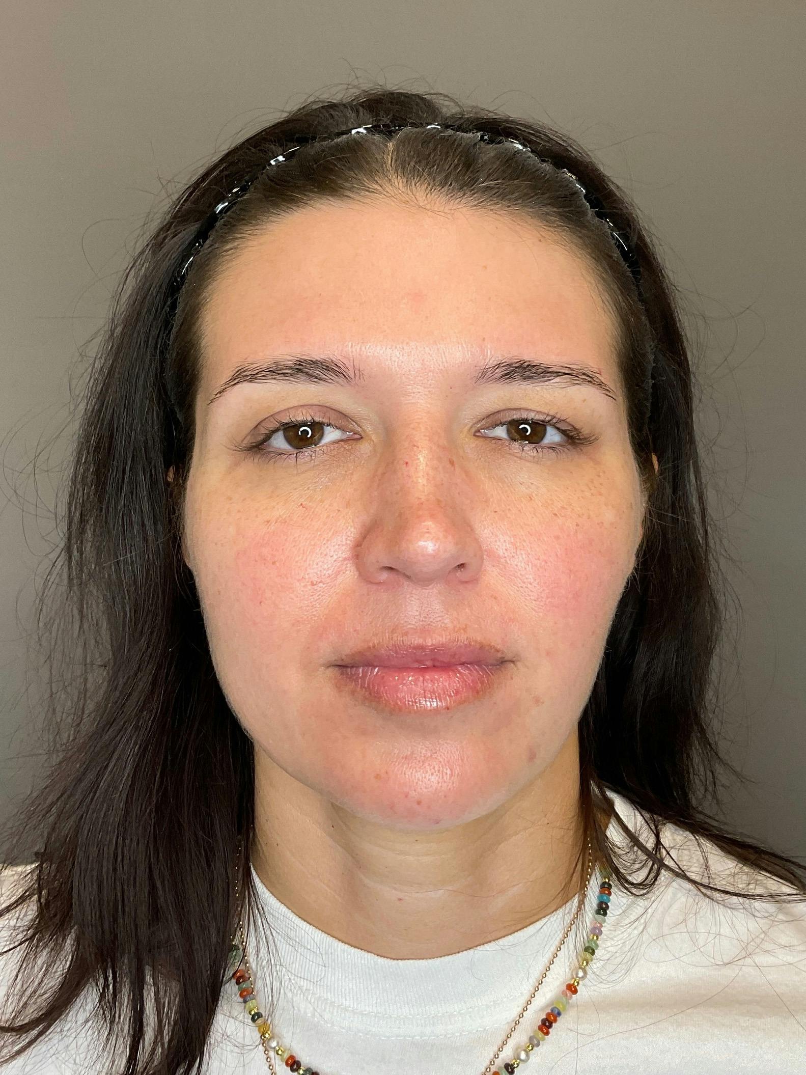 Lip Fillers Before & After Gallery - Patient 416038 - Image 1
