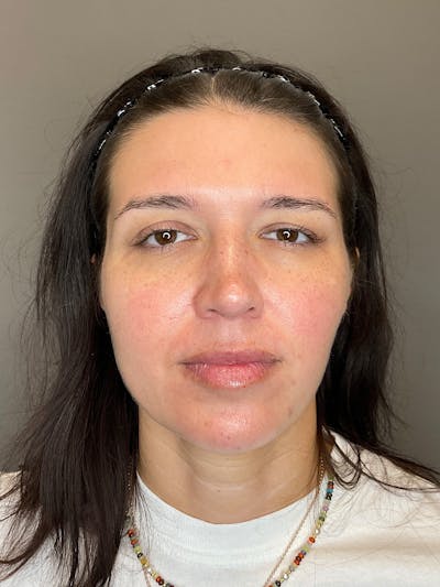 Chin Before & After Gallery - Patient 187242 - Image 1