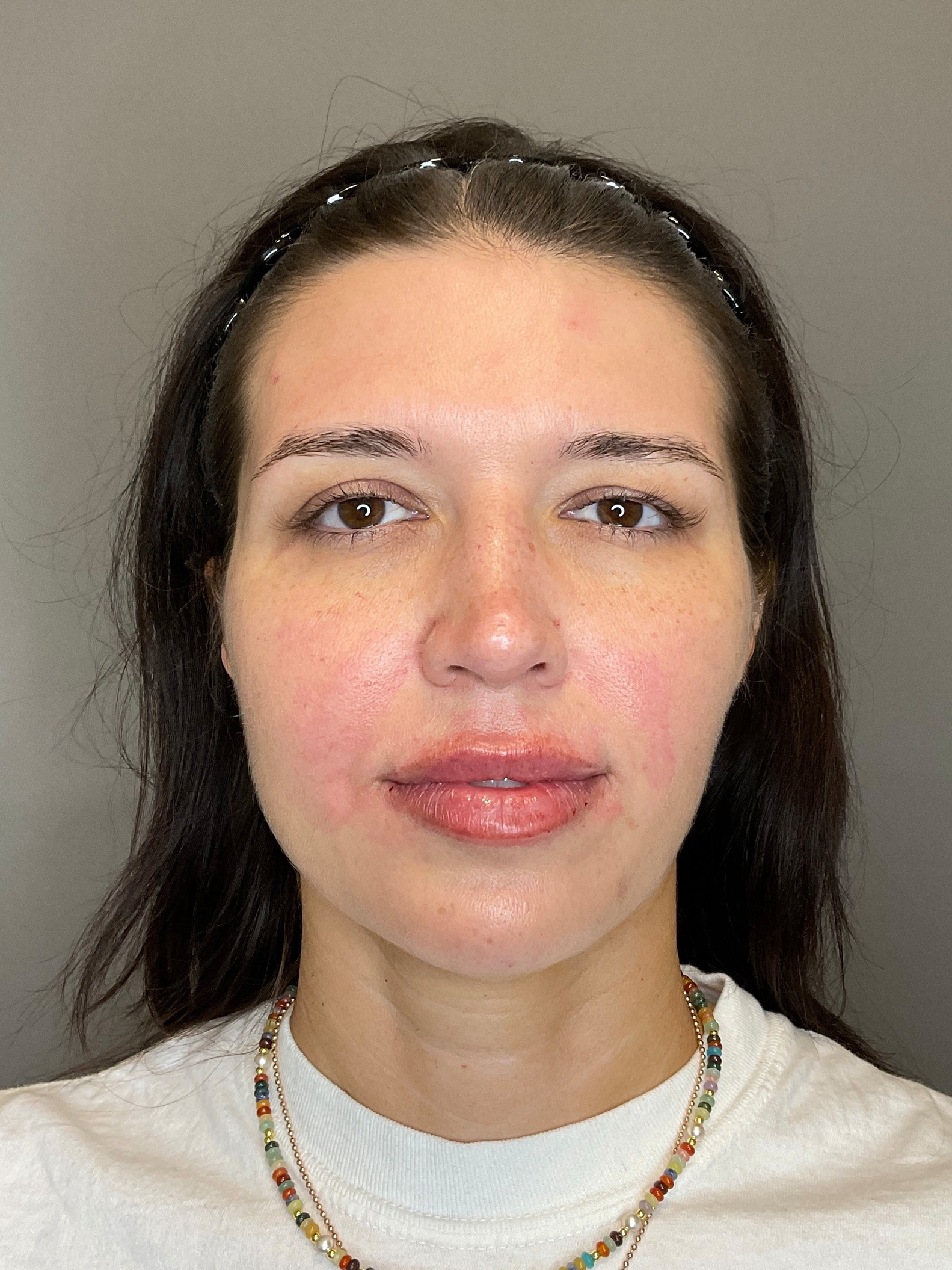 Chin Before & After Gallery - Patient 187242 - Image 2