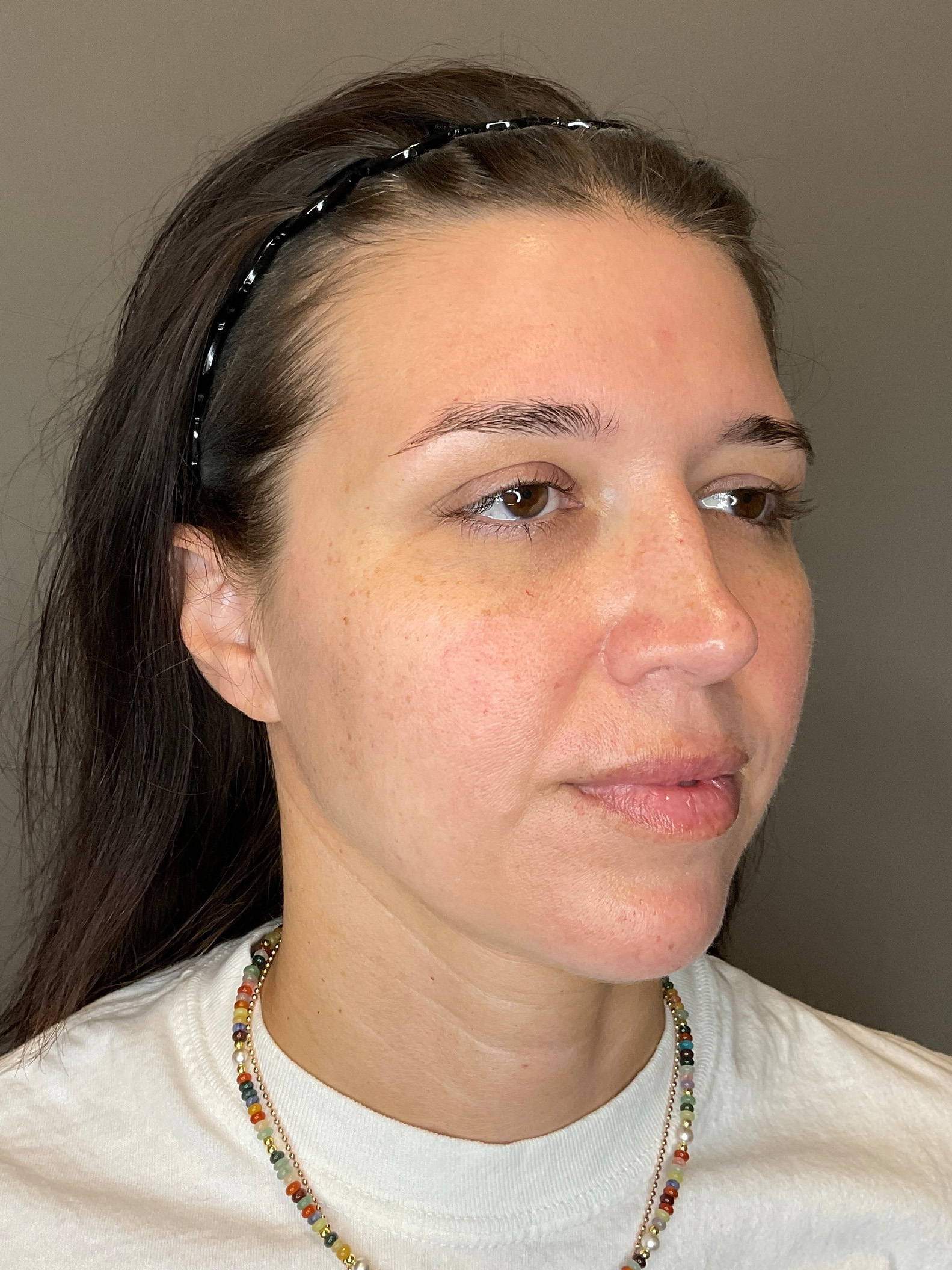 Chin Before & After Gallery - Patient 187242 - Image 3