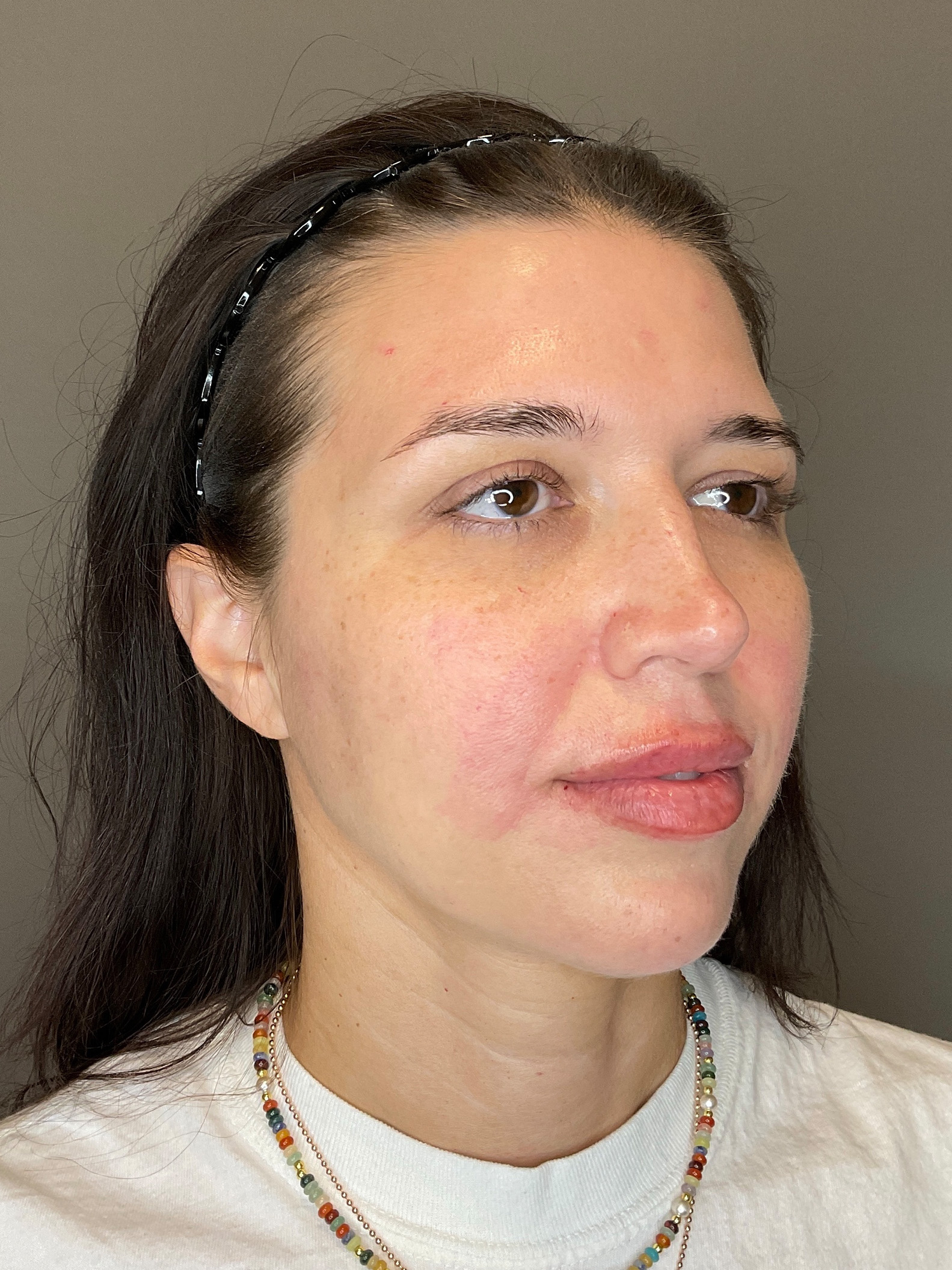 Chin Before & After Gallery - Patient 187242 - Image 4