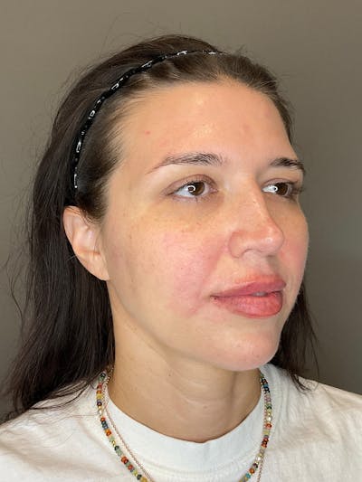 Chin Before & After Gallery - Patient 187242 - Image 4