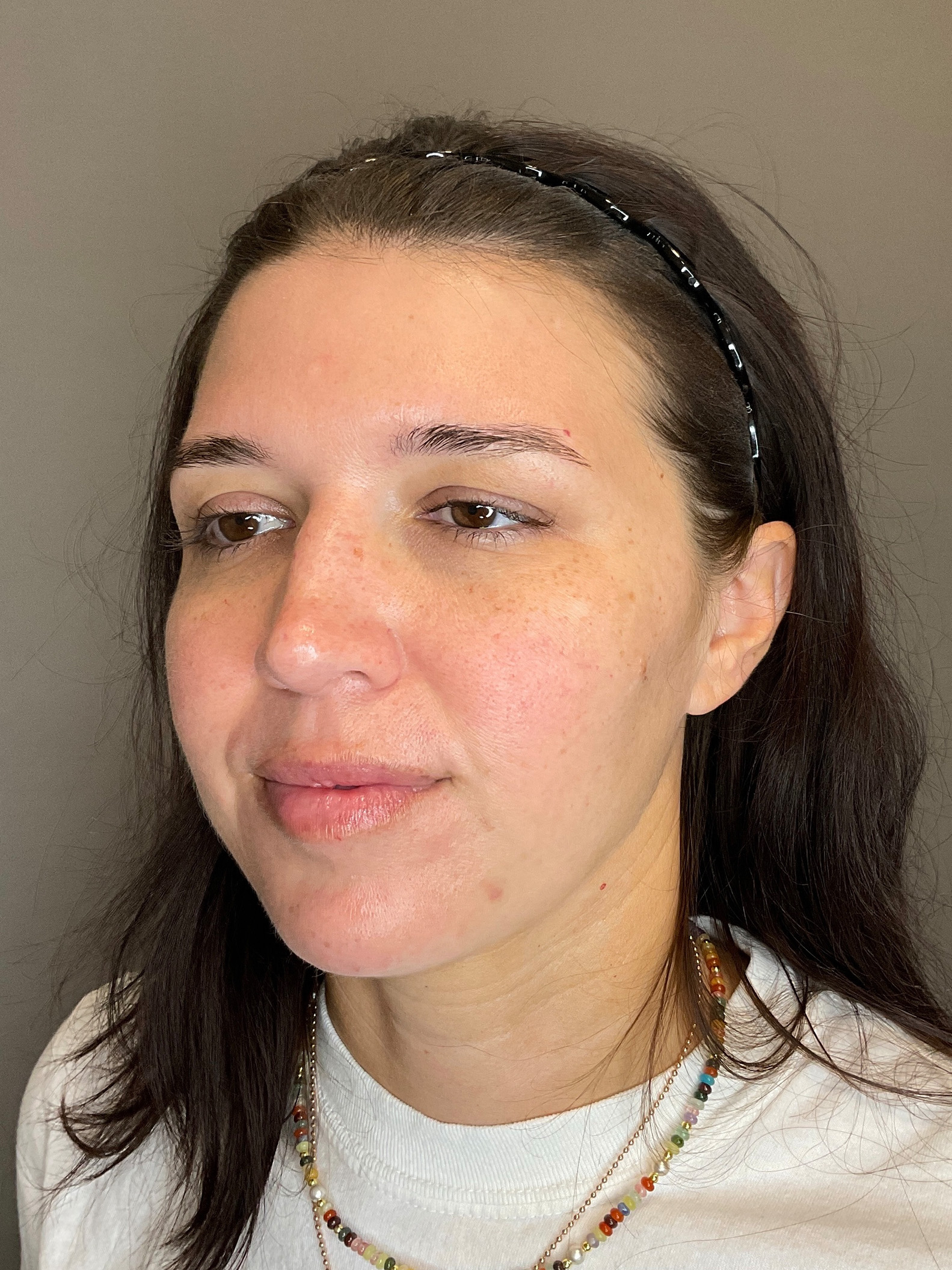 Chin Before & After Gallery - Patient 187242 - Image 5