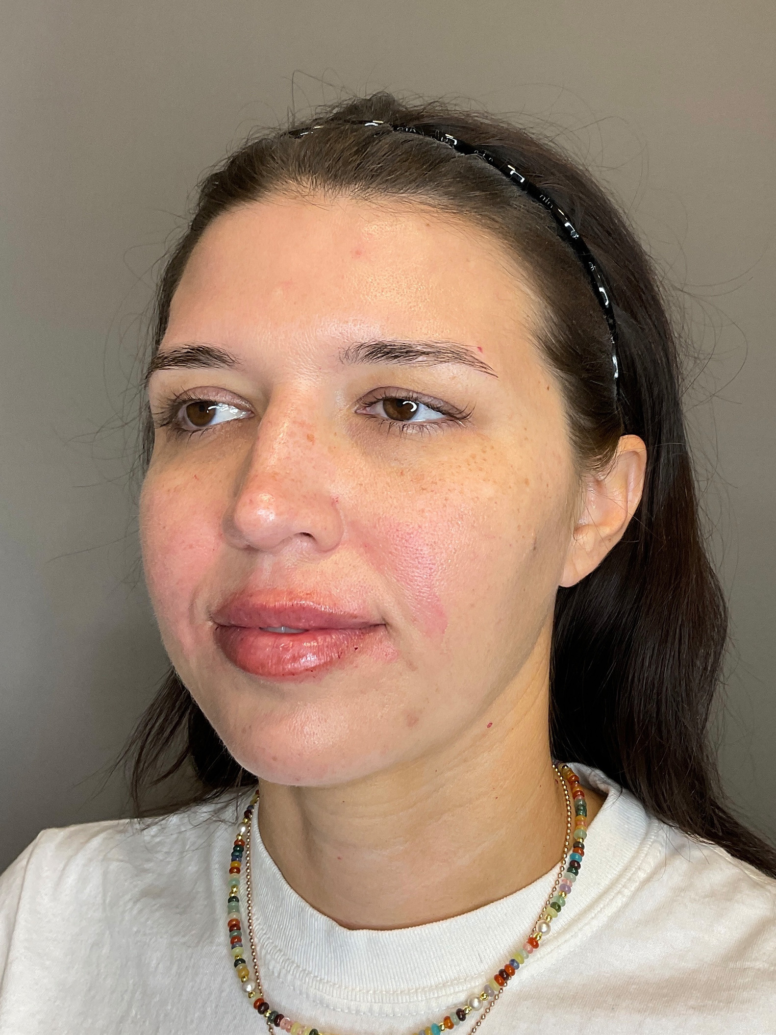 Chin Before & After Gallery - Patient 187242 - Image 6
