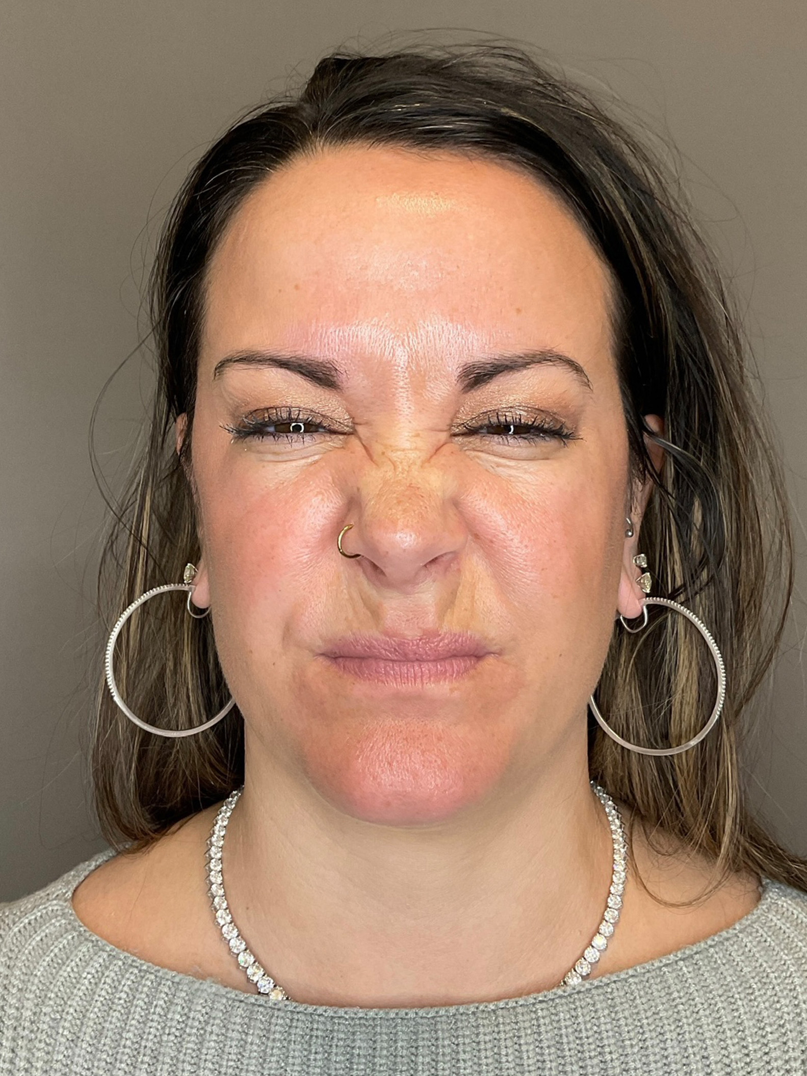 BOTOX Before & After Gallery - Patient 366095 - Image 1