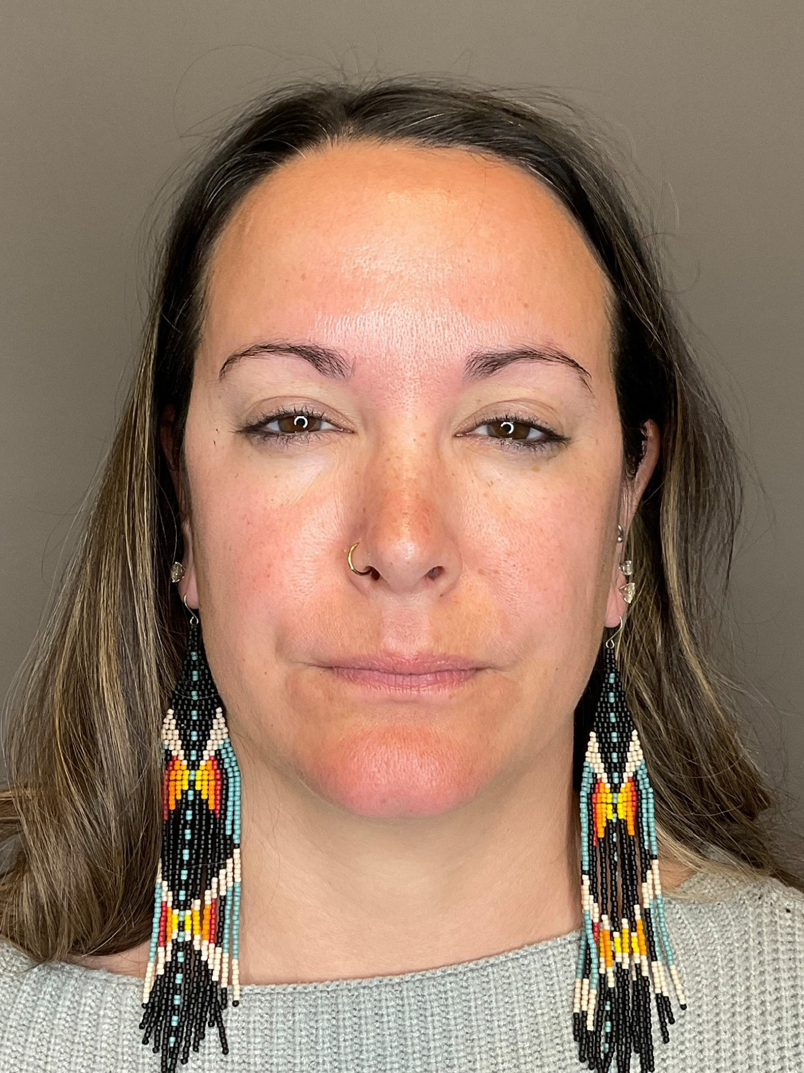 BOTOX Before & After Gallery - Patient 366095 - Image 2