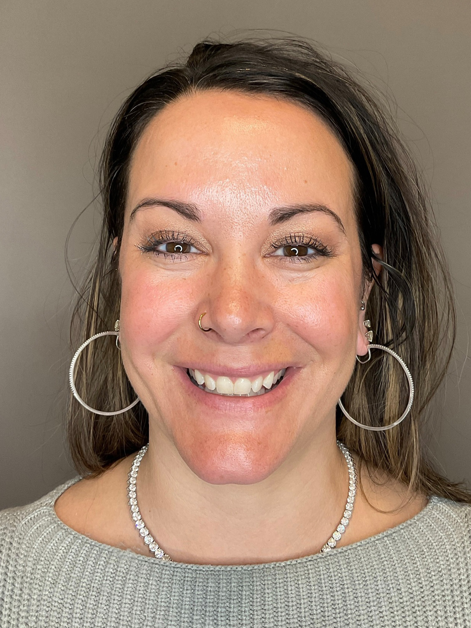BOTOX Before & After Gallery - Patient 366095 - Image 3