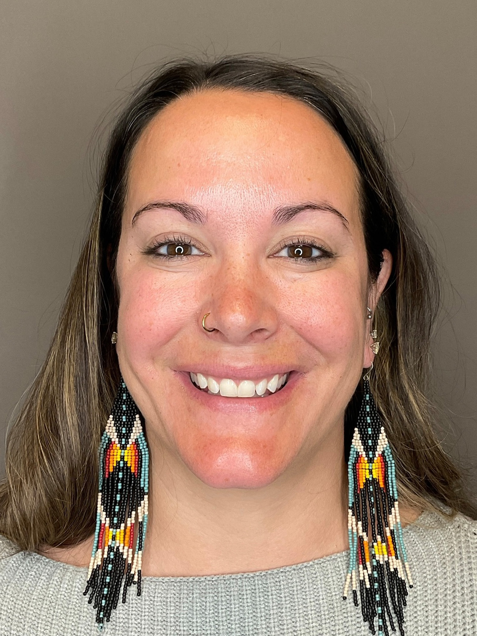 BOTOX Before & After Gallery - Patient 366095 - Image 4