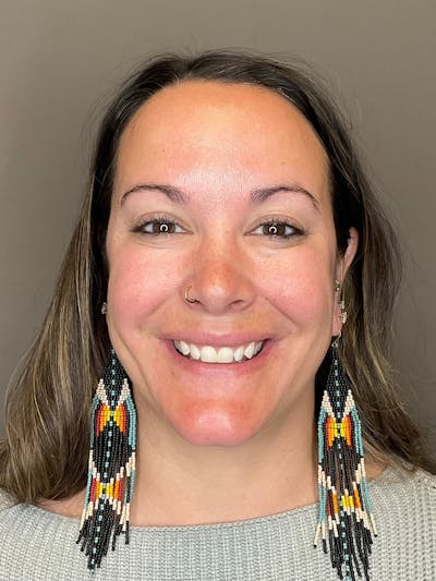 BOTOX Before & After Gallery - Patient 366095 - Image 4