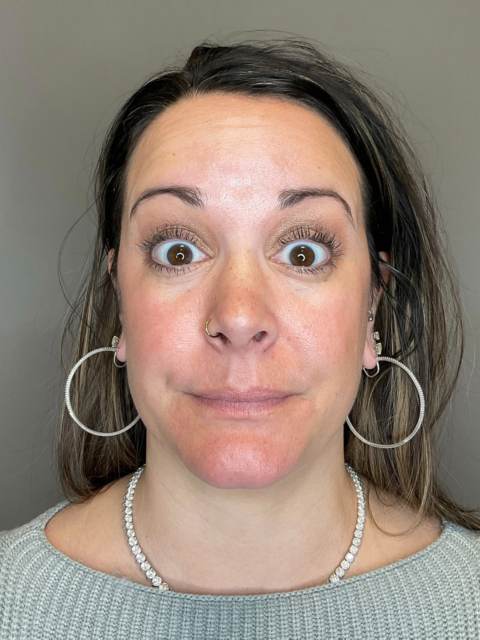 BOTOX Before & After Gallery - Patient 366095 - Image 5