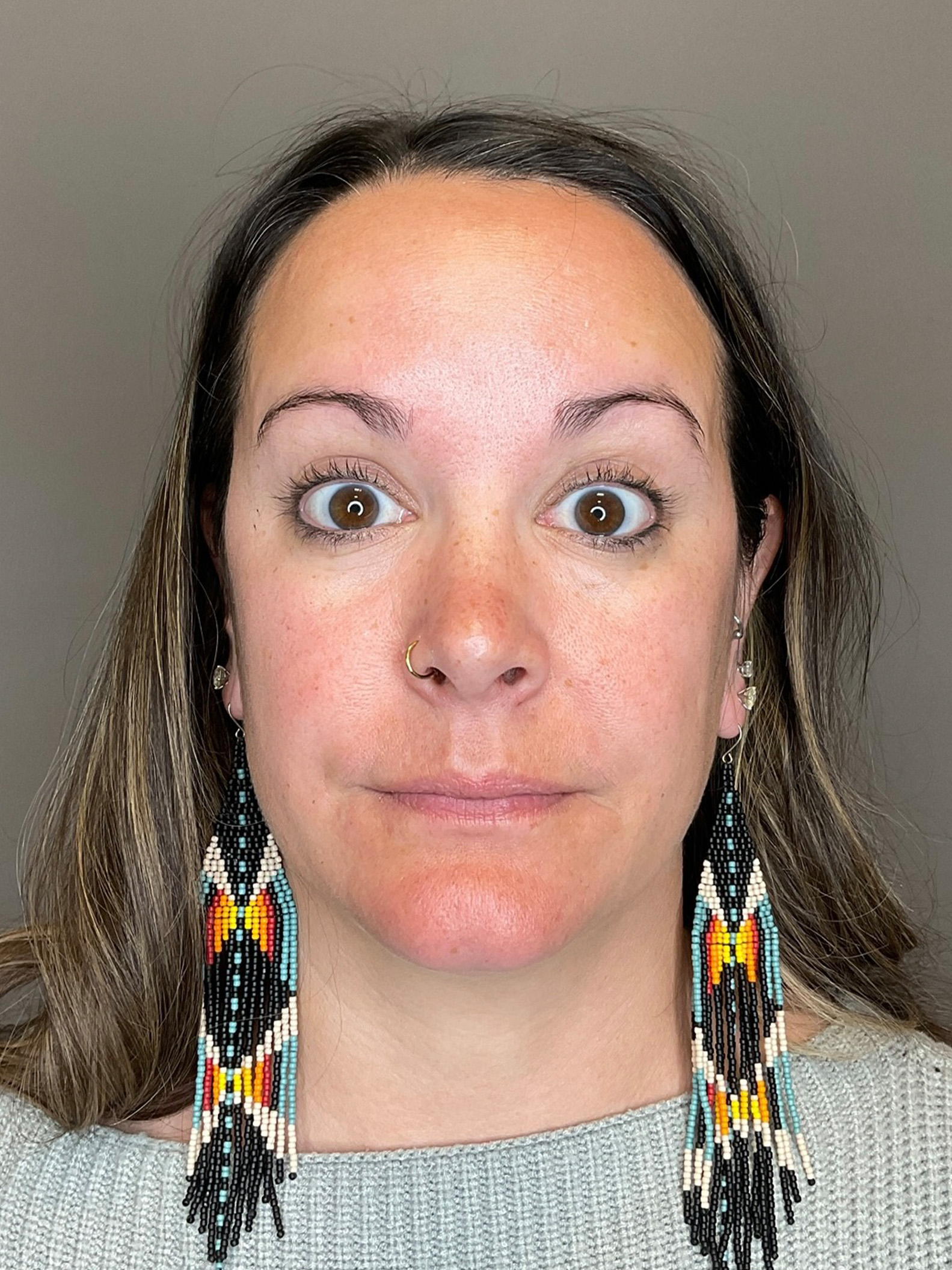 BOTOX Before & After Gallery - Patient 366095 - Image 6