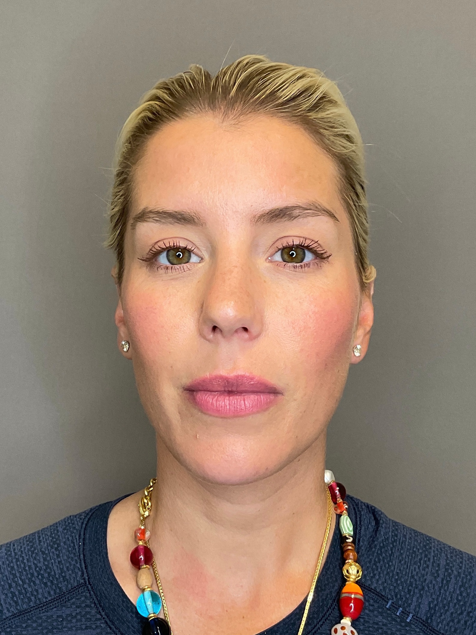 Facial Rejuvenation (Facial Balancing)  Before & After Gallery - Patient 322095 - Image 1