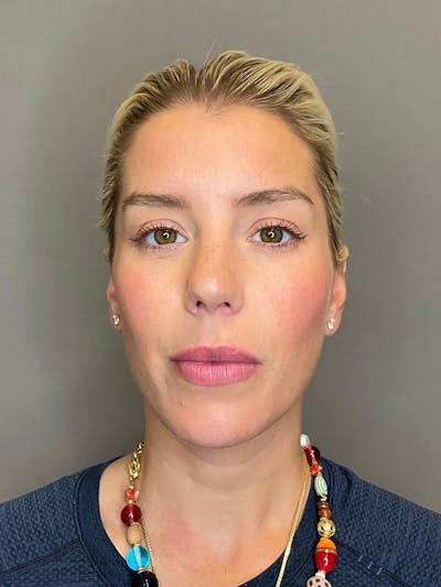 Facial Rejuvenation (Facial Balancing)  Before & After Gallery - Patient 322095 - Image 1