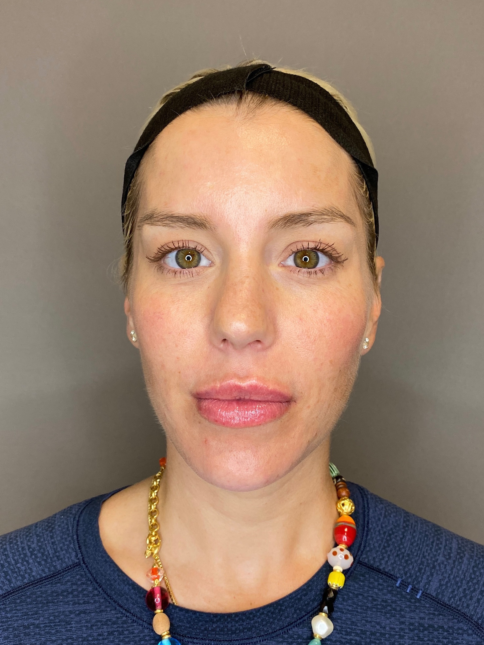 Facial Rejuvenation (Facial Balancing)  Before & After Gallery - Patient 322095 - Image 2
