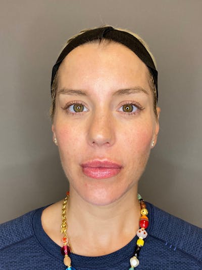 Facial Rejuvenation (Facial Balancing)  Before & After Gallery - Patient 322095 - Image 2