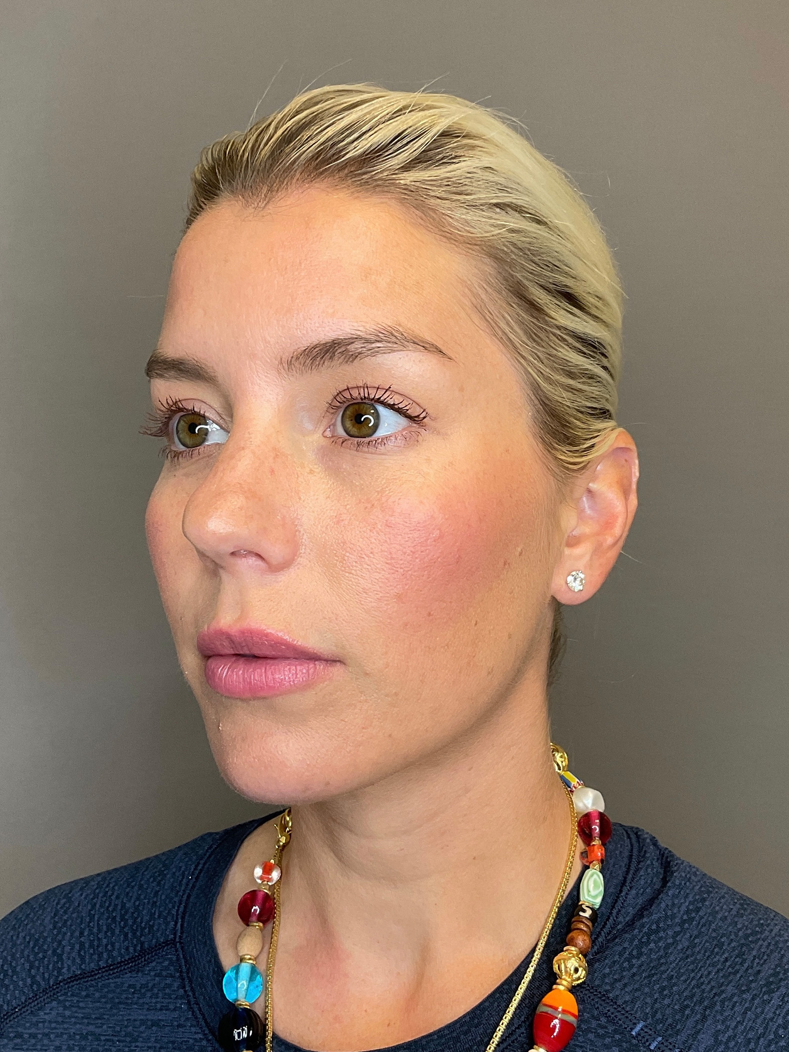 Facial Rejuvenation (Facial Balancing)  Before & After Gallery - Patient 322095 - Image 5