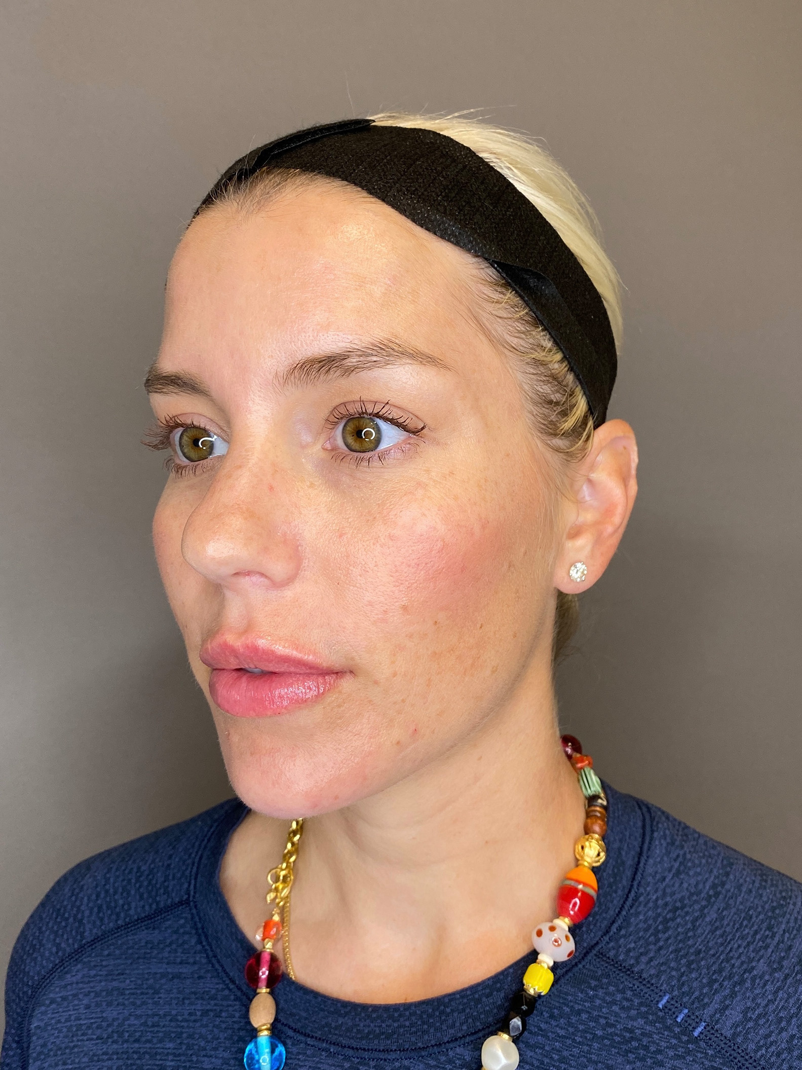 Facial Rejuvenation (Facial Balancing)  Before & After Gallery - Patient 322095 - Image 6