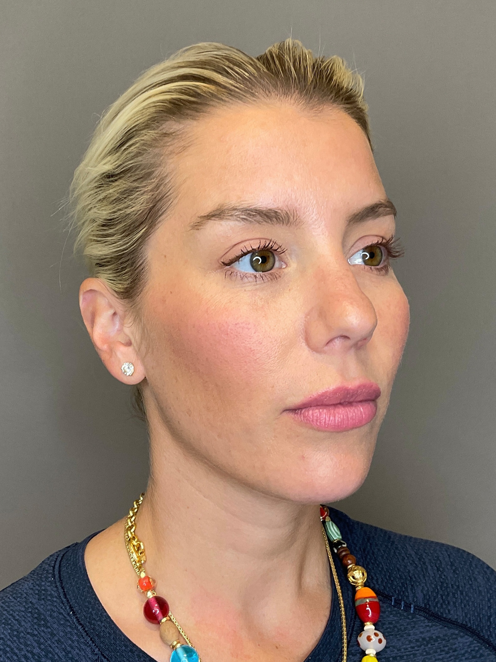 Facial Rejuvenation (Facial Balancing)  Before & After Gallery - Patient 322095 - Image 3