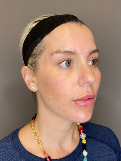 Facial Rejuvenation (Facial Balancing)  Before & After Gallery - Patient 322095 - Image 4