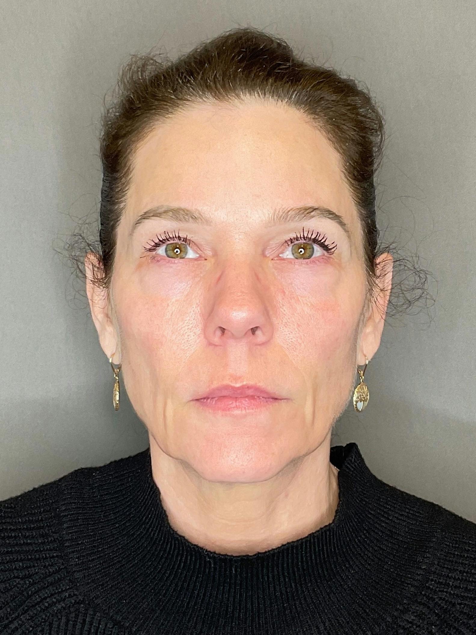 Lip Fillers Before & After Gallery - Patient 236906 - Image 1