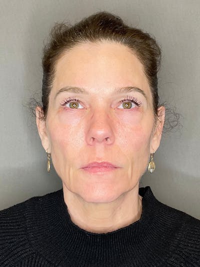Facial Rejuvenation (Facial Balancing)  Before & After Gallery - Patient 172684 - Image 1