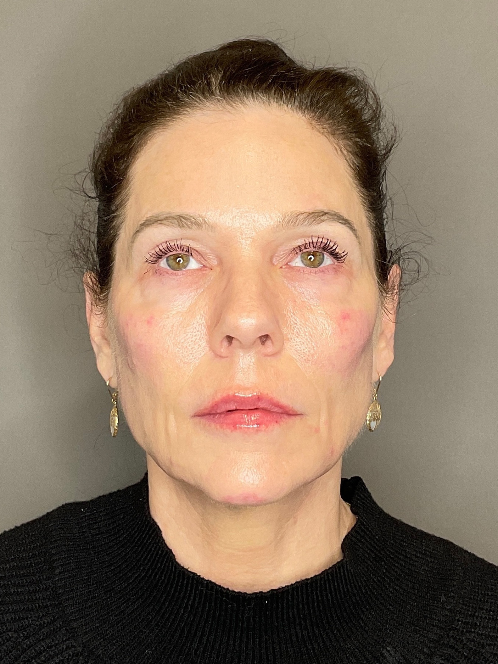 Facial Rejuvenation (Facial Balancing)  Before & After Gallery - Patient 172684 - Image 2