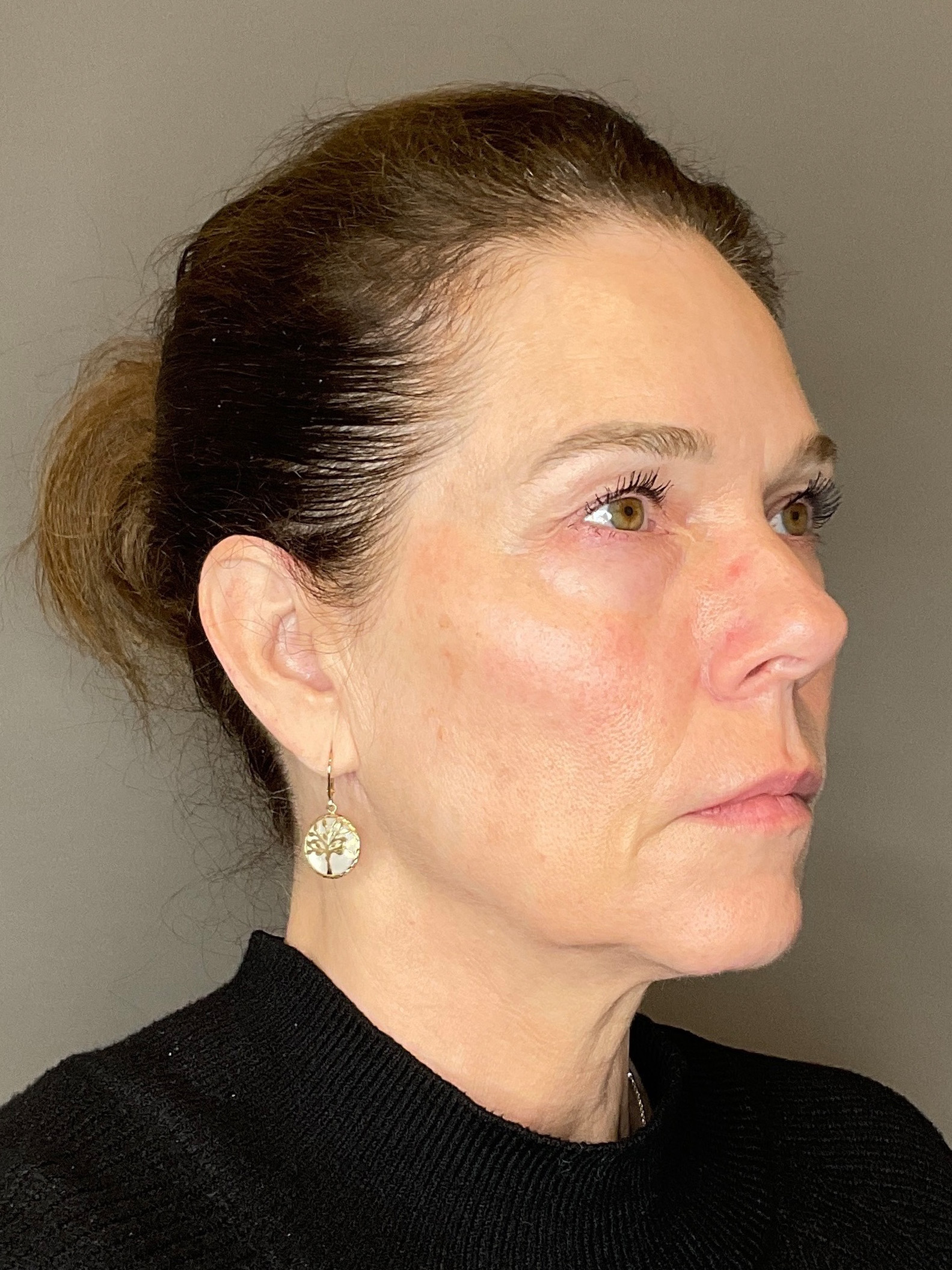 Facial Rejuvenation (Facial Balancing)  Before & After Gallery - Patient 172684 - Image 3