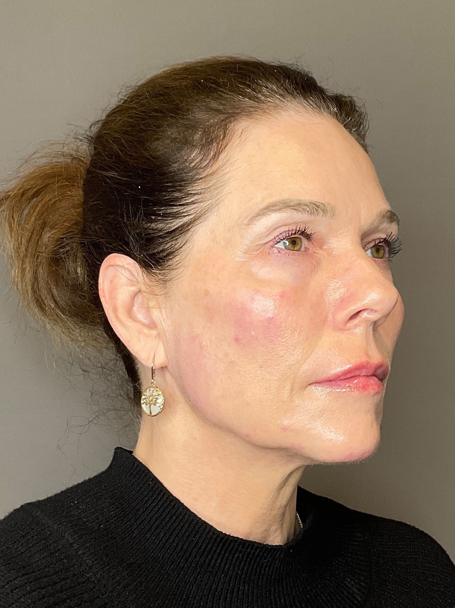 Facial Rejuvenation (Facial Balancing)  Before & After Gallery - Patient 172684 - Image 4
