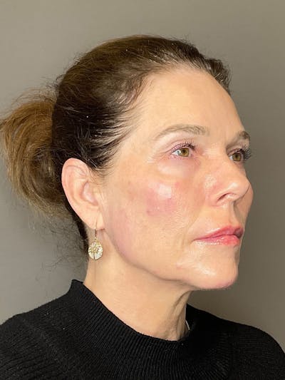 Facial Rejuvenation (Facial Balancing)  Before & After Gallery - Patient 172684 - Image 4