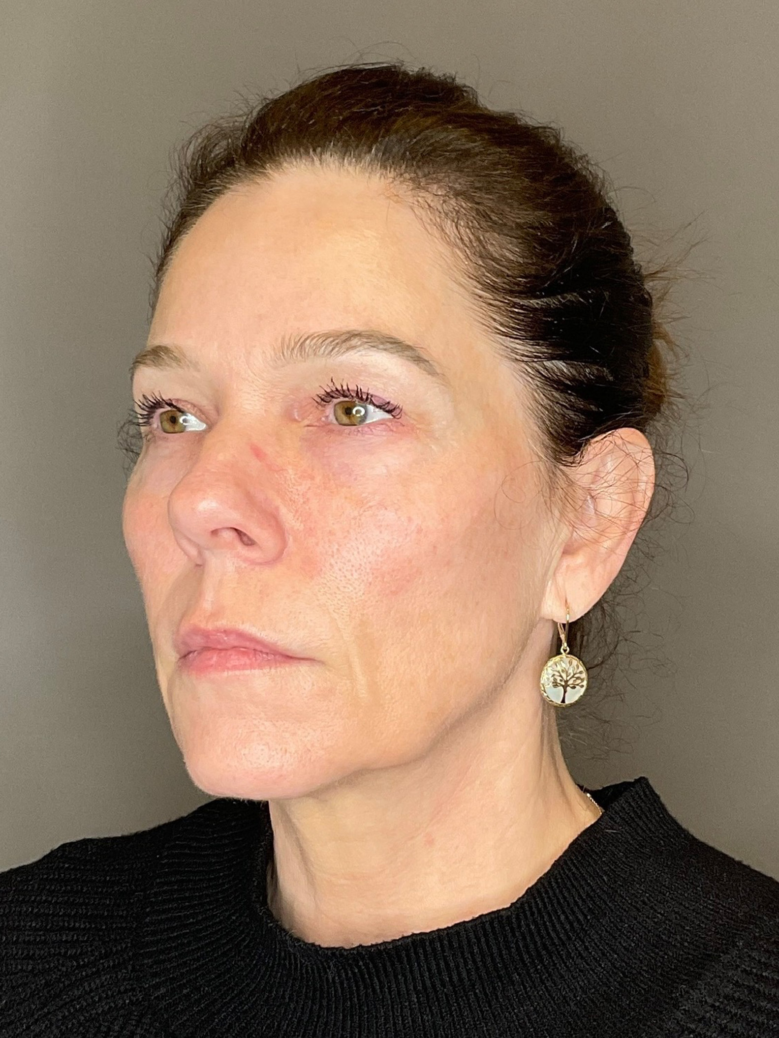 Facial Rejuvenation (Facial Balancing)  Before & After Gallery - Patient 172684 - Image 5