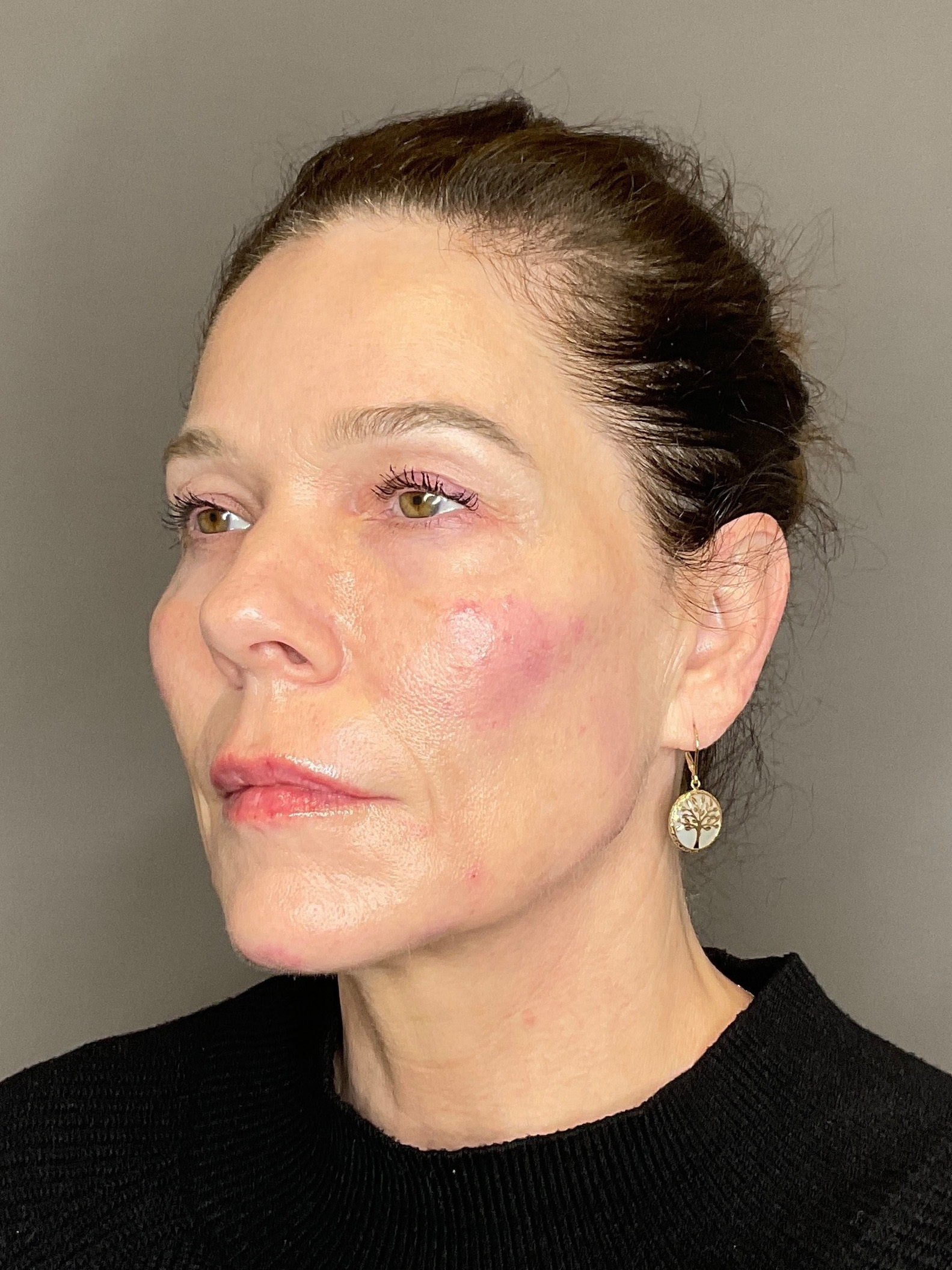 Facial Rejuvenation (Facial Balancing)  Before & After Gallery - Patient 172684 - Image 6