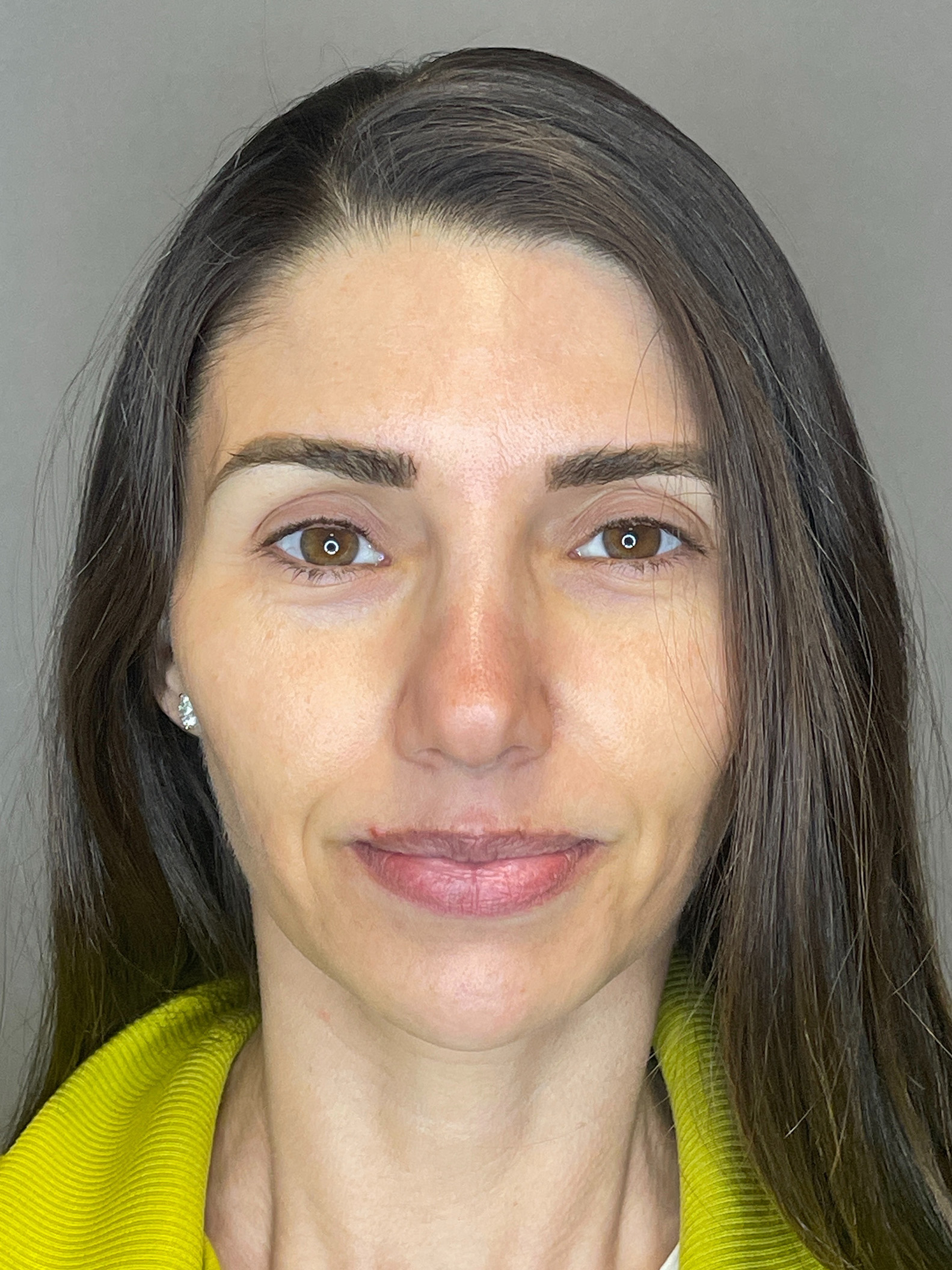 Laser Skin Resufacing Before & After Gallery - Patient 276650 - Image 1