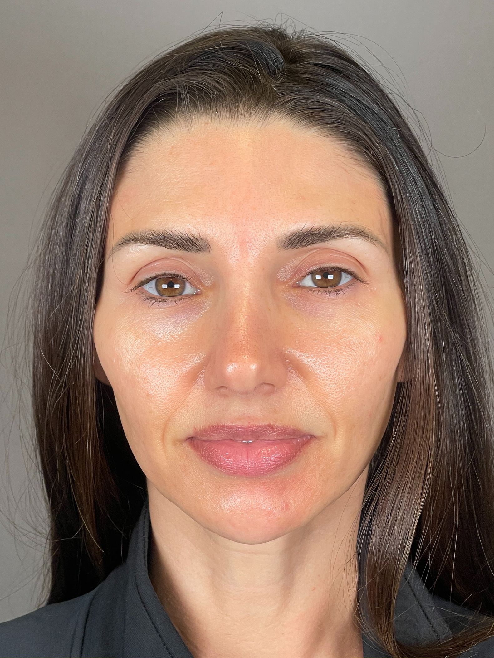Laser Skin Resufacing Before & After Gallery - Patient 276650 - Image 2