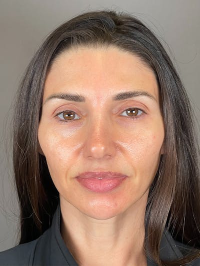 Laser Skin Resufacing Before & After Gallery - Patient 276650 - Image 2
