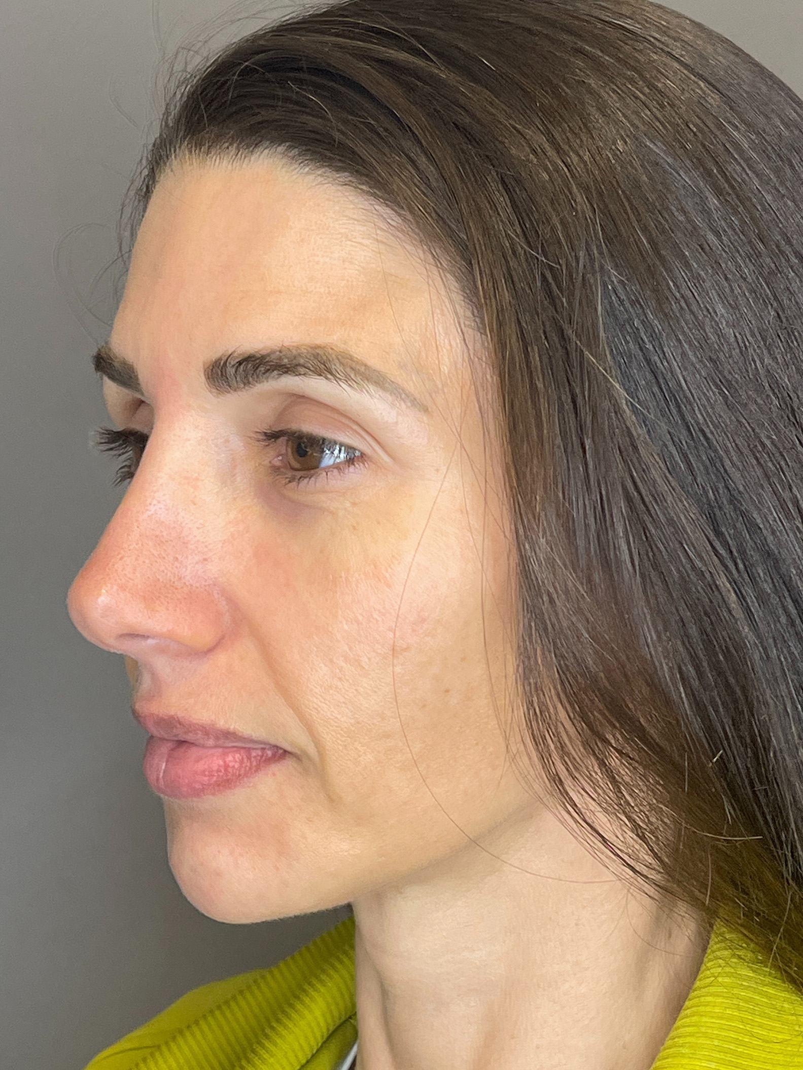 Laser Skin Resufacing Before & After Gallery - Patient 276650 - Image 5