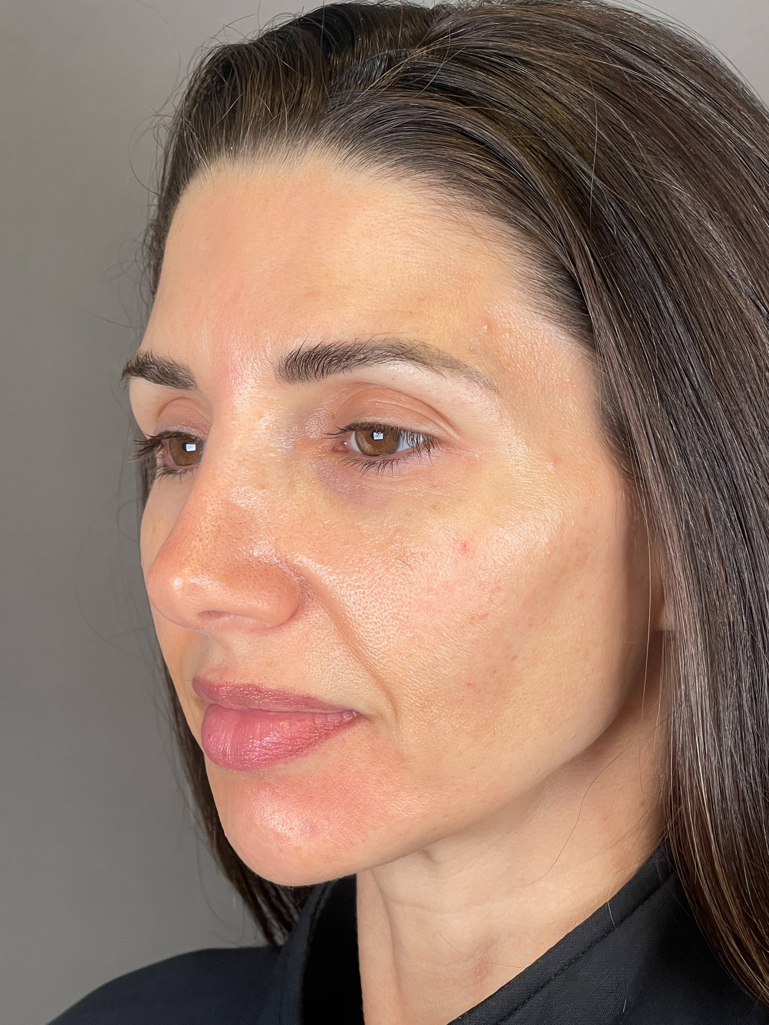 Laser Skin Resufacing Before & After Gallery - Patient 276650 - Image 6