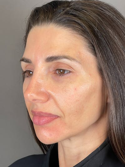 Laser Skin Resufacing Before & After Gallery - Patient 276650 - Image 6