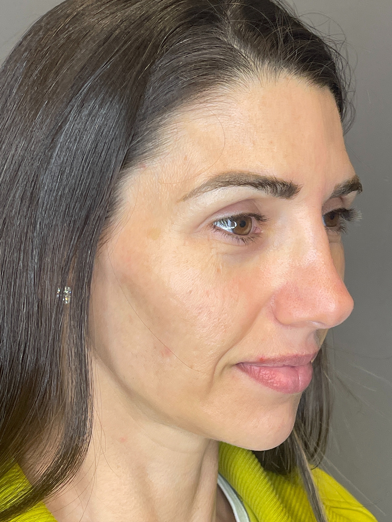 Laser Skin Resufacing Before & After Gallery - Patient 276650 - Image 3