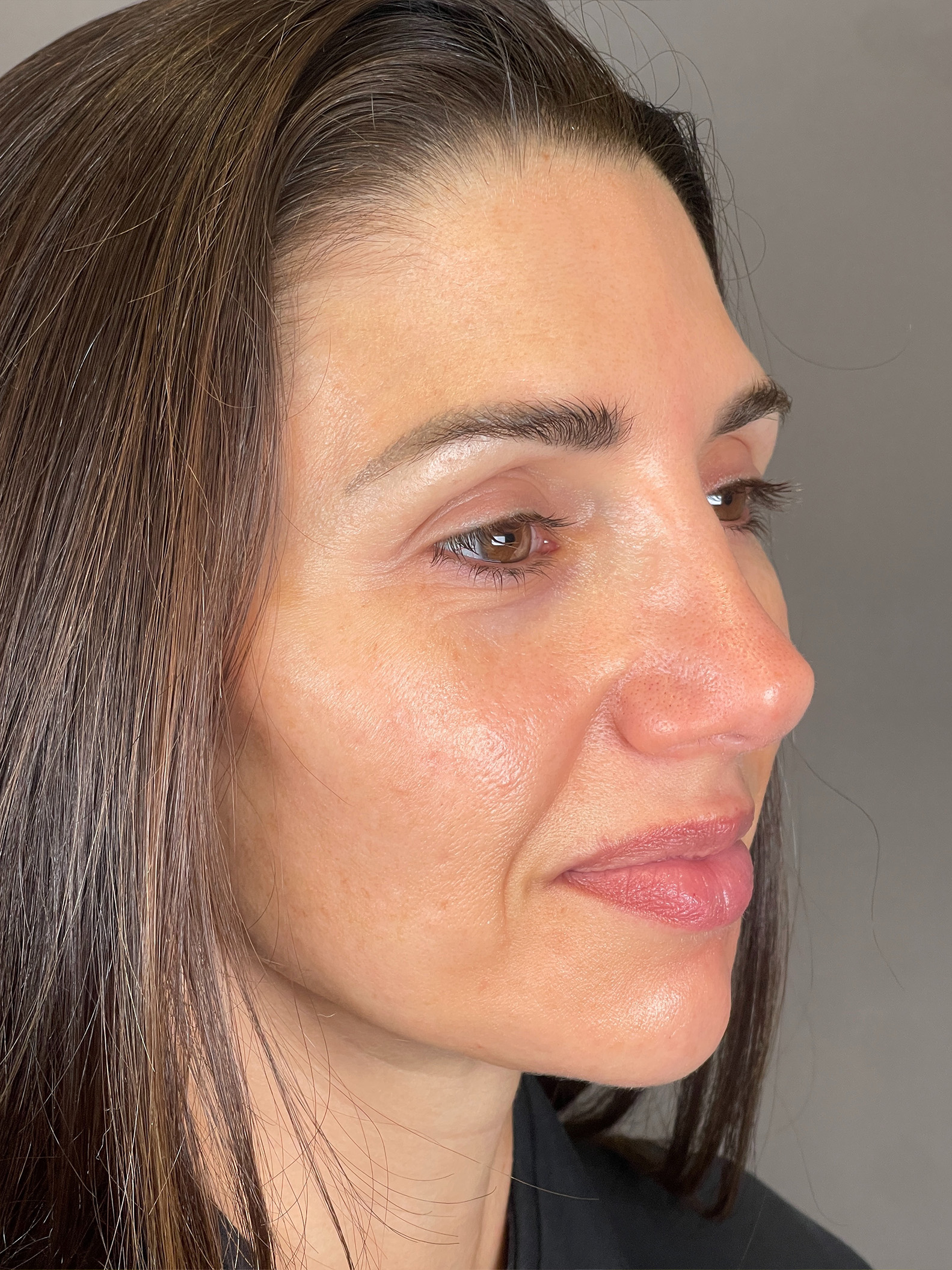 Laser Skin Resufacing Before & After Gallery - Patient 276650 - Image 4