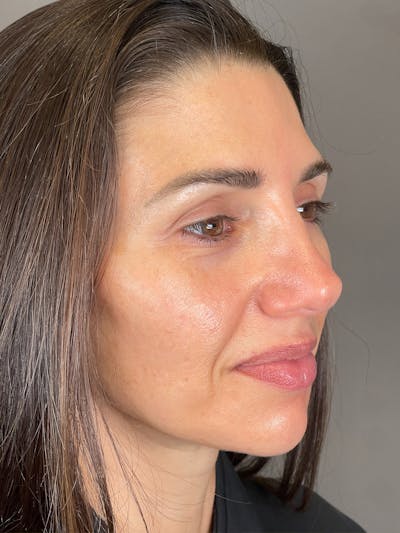 Laser Skin Resufacing Before & After Gallery - Patient 276650 - Image 4