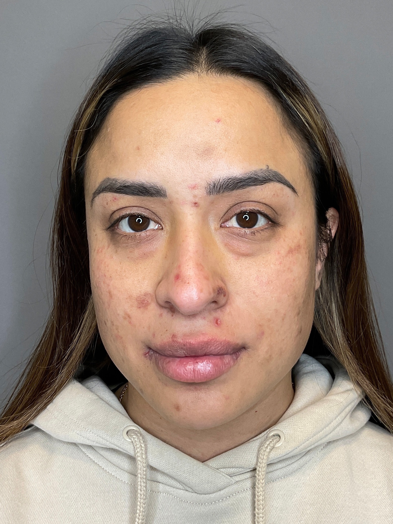 Laser Skin Resufacing Before & After Gallery - Patient 204309 - Image 1