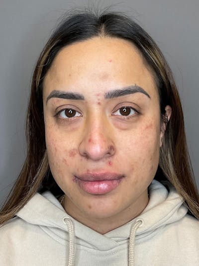 Laser Skin Resufacing Before & After Gallery - Patient 204309 - Image 1