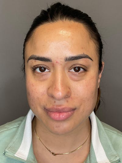 Laser Skin Resufacing Before & After Gallery - Patient 204309 - Image 2