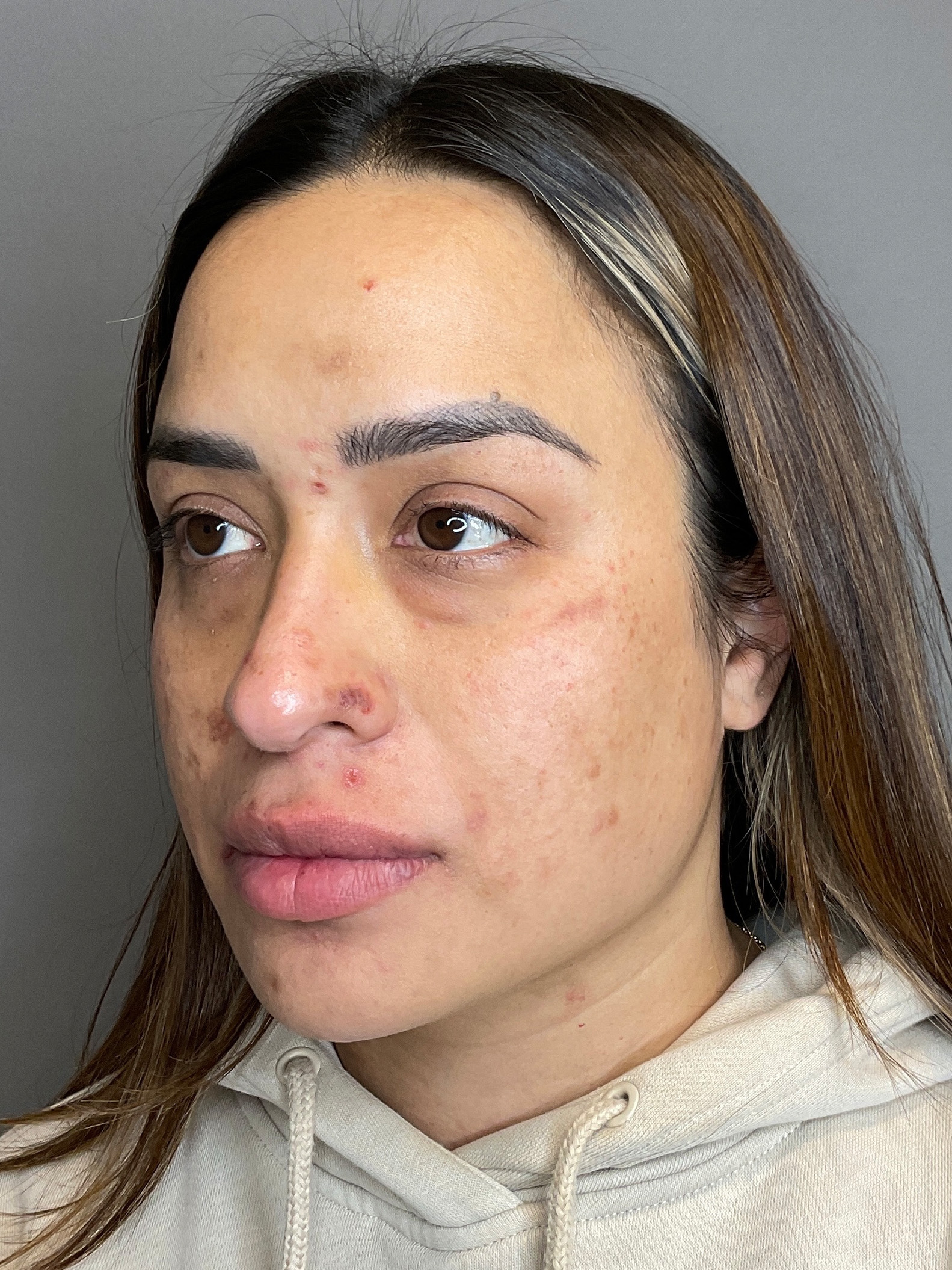 Laser Skin Resufacing Before & After Gallery - Patient 204309 - Image 3