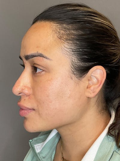 Laser Skin Resufacing Before & After Gallery - Patient 204309 - Image 4