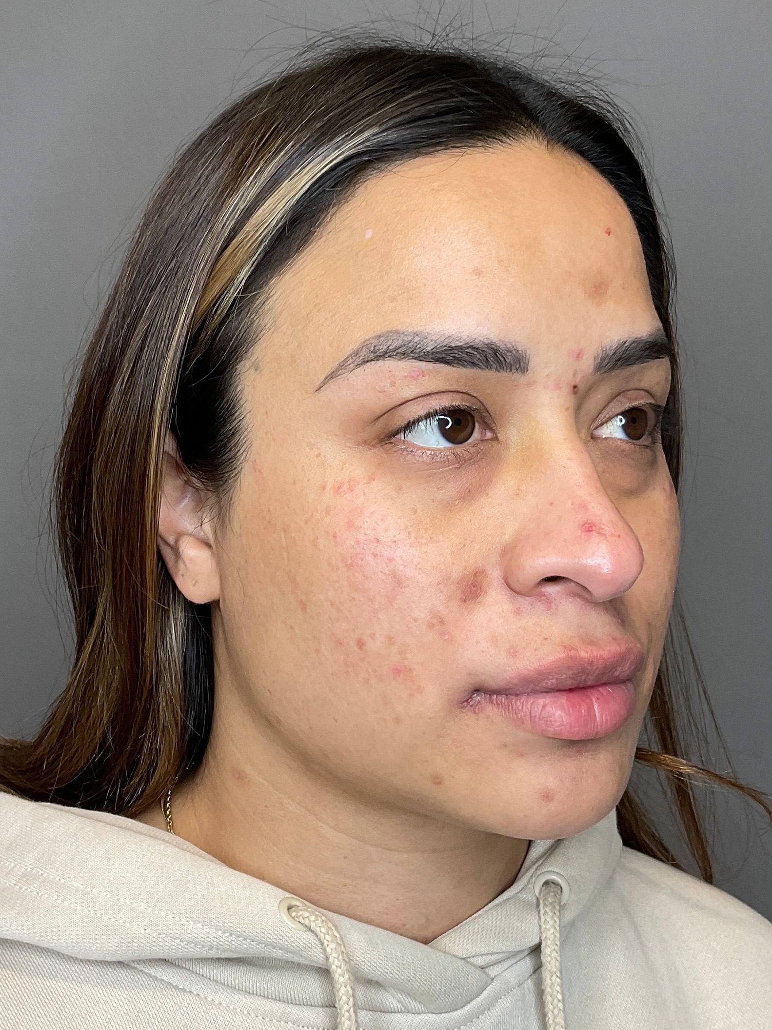Laser Skin Resufacing Before & After Gallery - Patient 204309 - Image 5