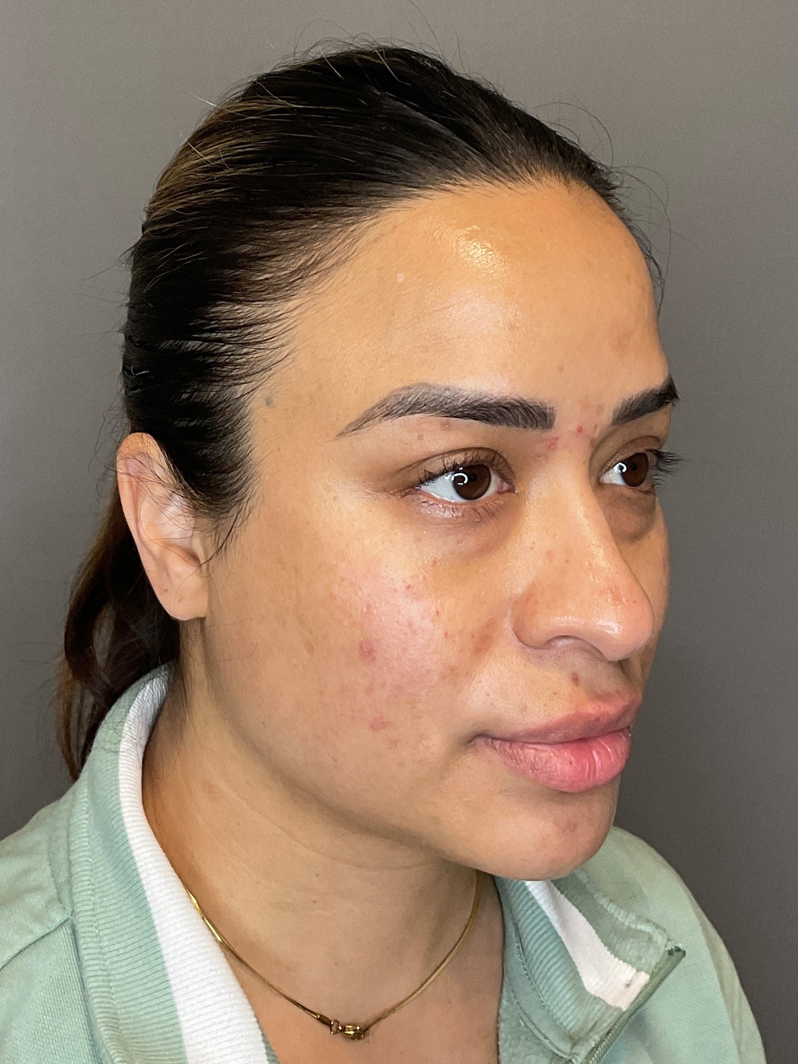 Laser Skin Resufacing Before & After Gallery - Patient 204309 - Image 6