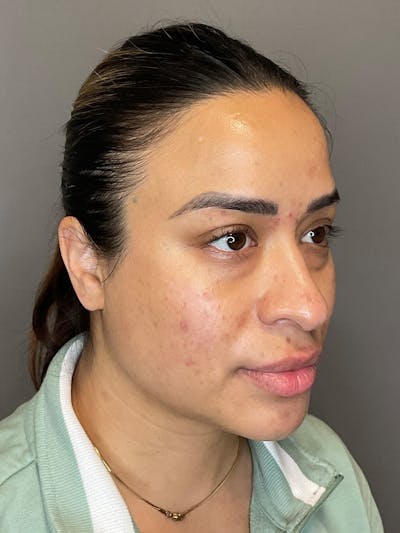 Laser Skin Resufacing Before & After Gallery - Patient 204309 - Image 6