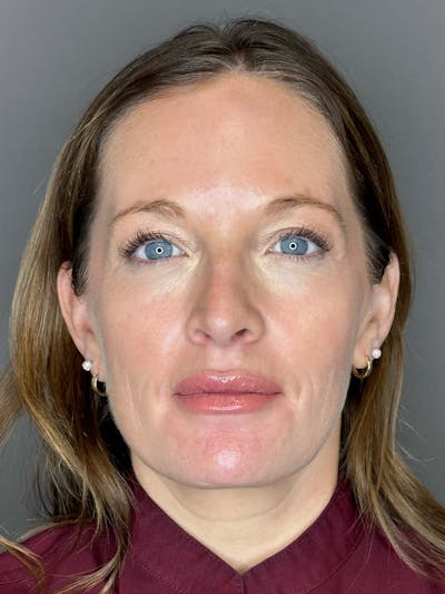 Microneedling with SkinPen Before & After Gallery - Patient 167838 - Image 1